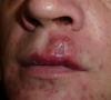 Сифилис на губе Первичный сифилис на губах